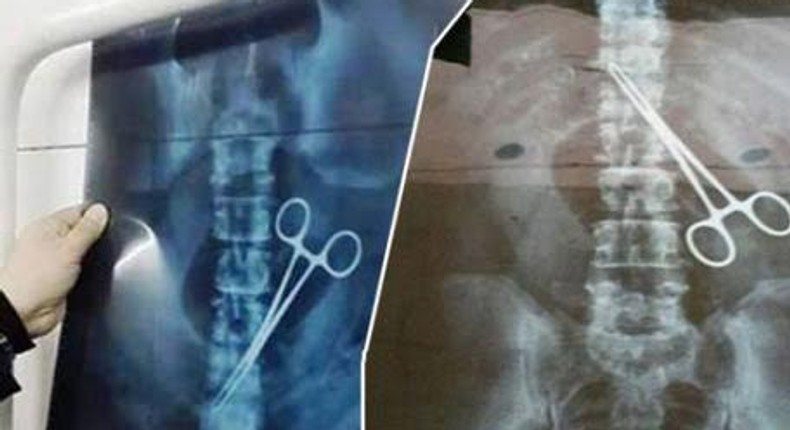 X ray reveals scissors in Nigerian Pilgrims belly In Saudi Arabia