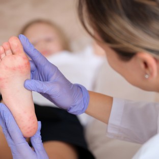 Körömgomba, lábgomba gyermekeknél: így lehet megelőzni a legkönnyebben