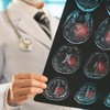 Lakunarni moždani udar  je po život opasno medicinsko stanje 