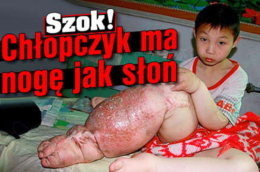 Chłopczyk ma nogę jak słoń