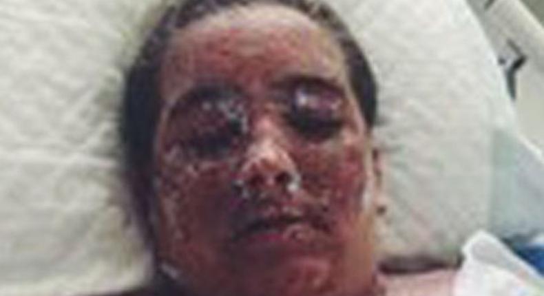29-yr-old Sarah Cole sustained burns over 98 percent of her body after bathing with warm water mixed with bleach in a bid to get rid of exzema