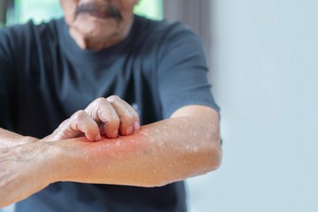 Apukám rühes, elkaphatjuk mi is, akik vele élünk? Az orvos válaszol