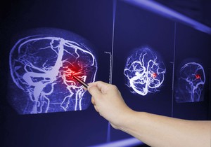 Proširenje arterija ključni uzrok lakunarnog ishemijskog moždanog udara