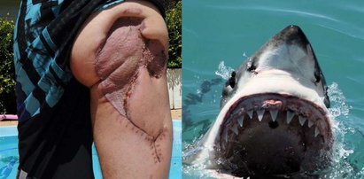 Oto pośladek po ataku rekina! FOTO od 18 lat