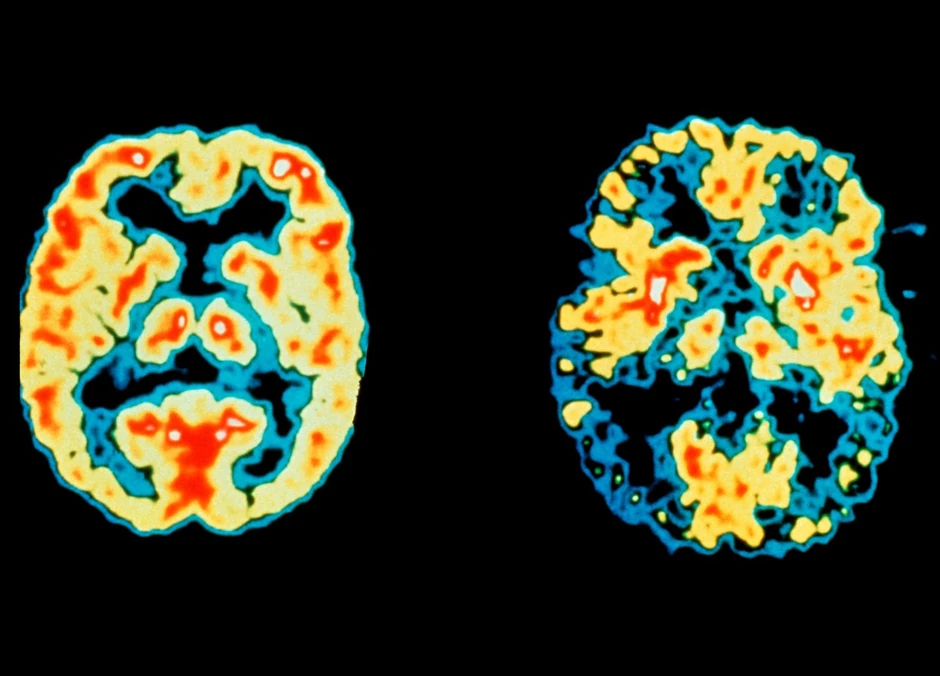 Normalan i mozak oboleo od Alchajmera