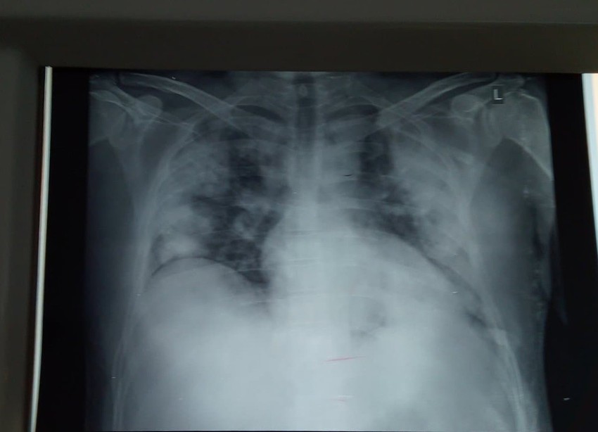 Rendgen snimak pluća obolelog od kovida 