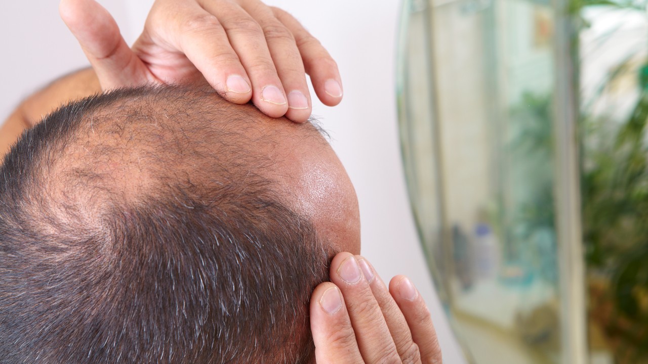 Nie chcesz tracić włosów? Jak najszybciej odstaw te napoje. Naukowcy ostrzegają: ponad trzykrotnie większe ryzyko