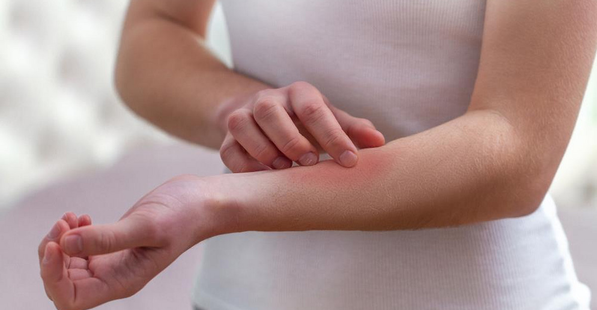 Poznaj alergię na własnej skórze – pokrzywka