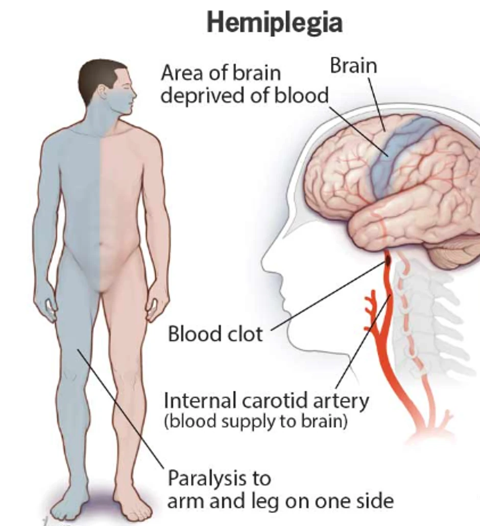 Hemiplegija može da zahvati lice, ruku i nogu, a ponekad i sve tri regije