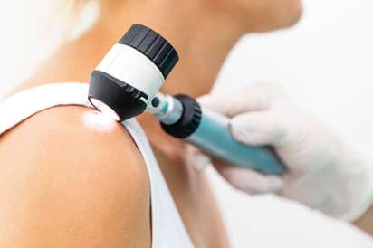 Megváltozott az anyajegye? Ha így néz ki, melanoma kialakulására utalhat