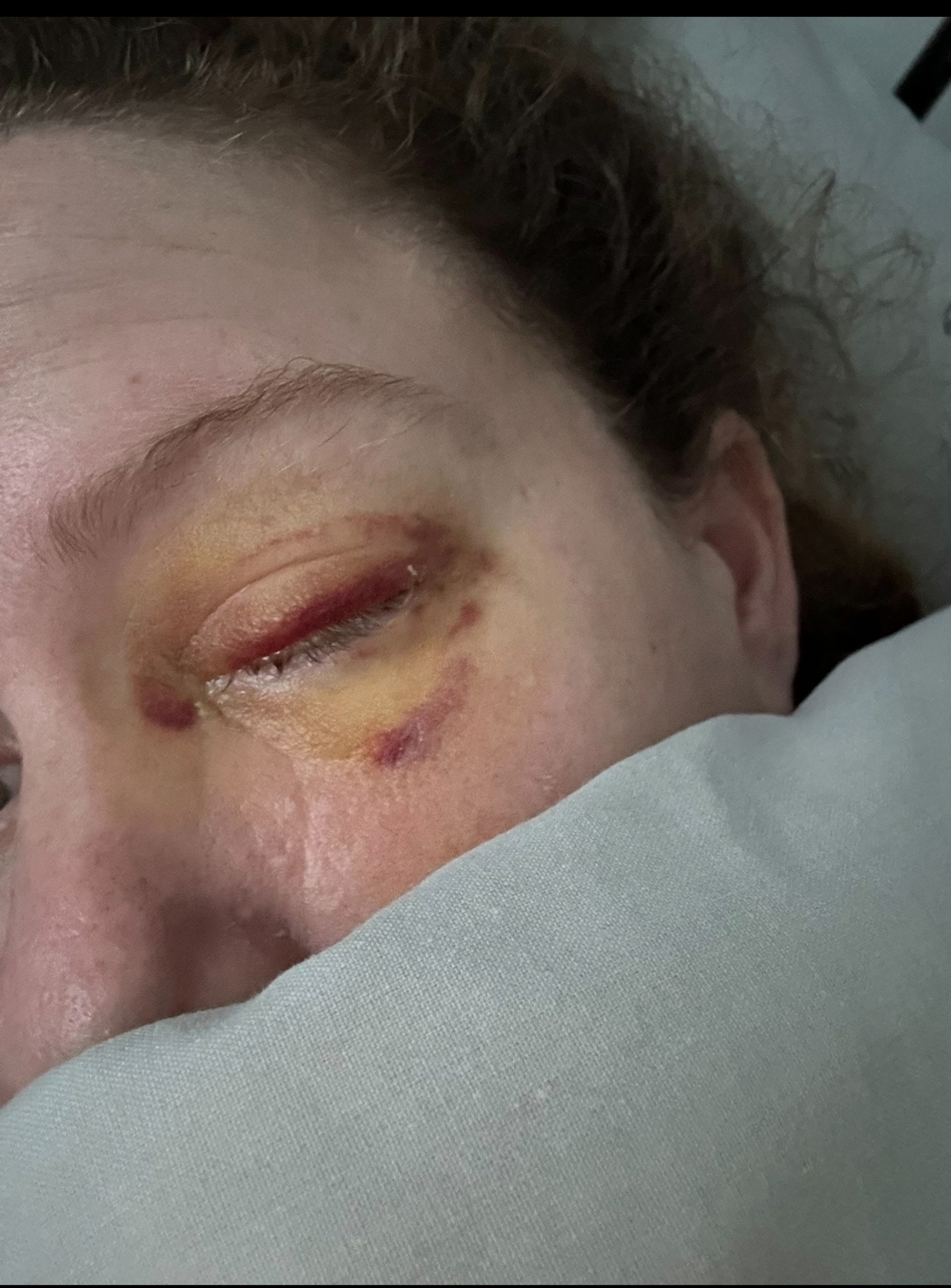 Rakovina mladej mamičke vzala oko.