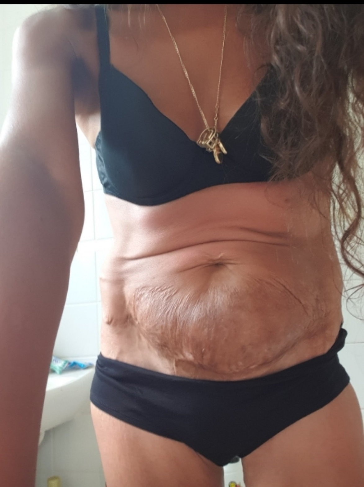 Rutinný zákrok sa pre Kelly skončil sepsou a doživotným utrpením.