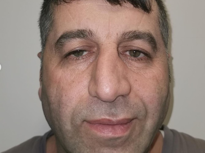 Turci estetskom hirurgijom od uvenulog muškarca napravili brutalnog frajera