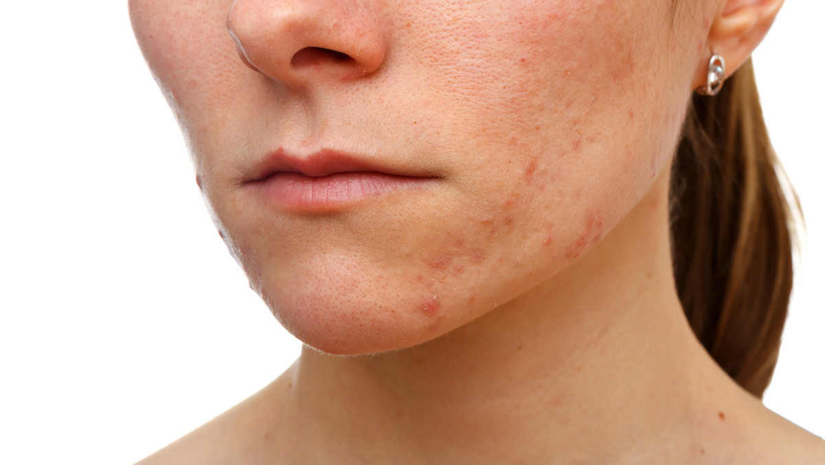 <strong>Acne Derm</strong> to <strong>maść</strong> dostępna bez recepty o działaniu przeciwtrądzikowym i wybielającym przebarwienia. <strong>Maść Acne Derm</strong> dostępna jest bez recepty, a cena 1 opakowania to ok. 15 zł.