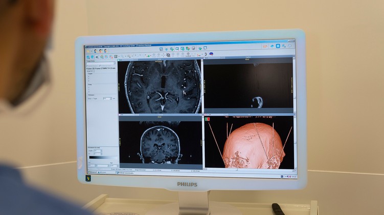 mély agyi stimuláció deep brain stimulation dbs kezelés leírás