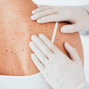 Bőrrák: új diagnosztikai és terápiás eljárásokat fejlesztenek magyar kutatók