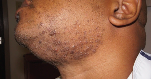 5 Fast Ways To Treat Razor Bumps At Home Pulse Ghana
