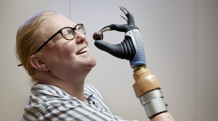 Az igazi bionikus nőnek nevezett beteg lett az első ember, akit ideg- és csontrendszerével összenőt, irányítható végtaggal szereltek fel / Fotó: Northfoto