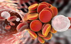 Nowa metoda leczenia zakrzepicy żył głębokich. Pierwsze takie operacje w Polsce