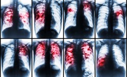 Gruźlica w Polsce nadal ma się „dobrze”. Niektóre jej szczepy się wymykają