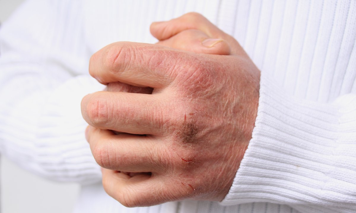 Krem ochronny z witaminą A za 5 zł na pękające od zimna dłonie. Lepszy niż luksusowe mazidła!