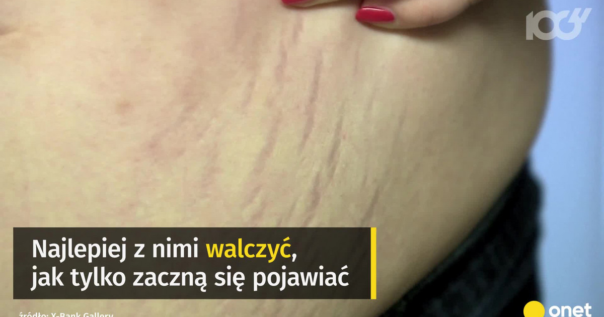 Dziewięć Sposobów Na Walkę Z Rozstępami Uroda 2801