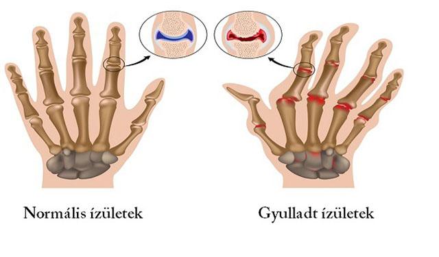 hogyan lehet azonosítani az ízületi gyulladást