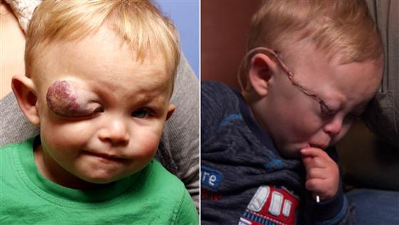 Chłopiec przed i po operacji
