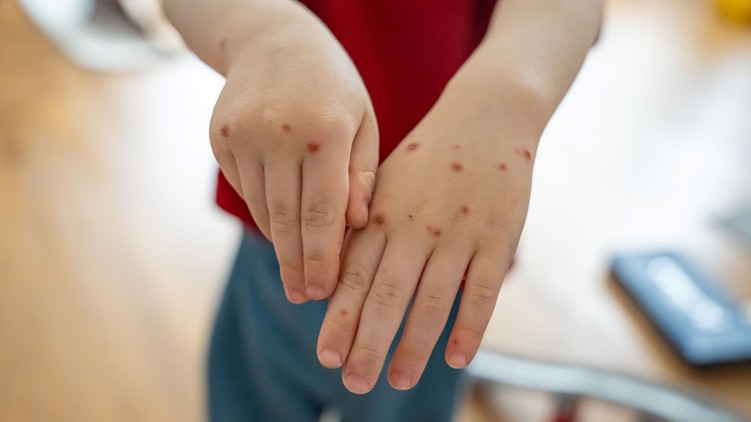 Coxsackie-vírus Ukrajna járvány