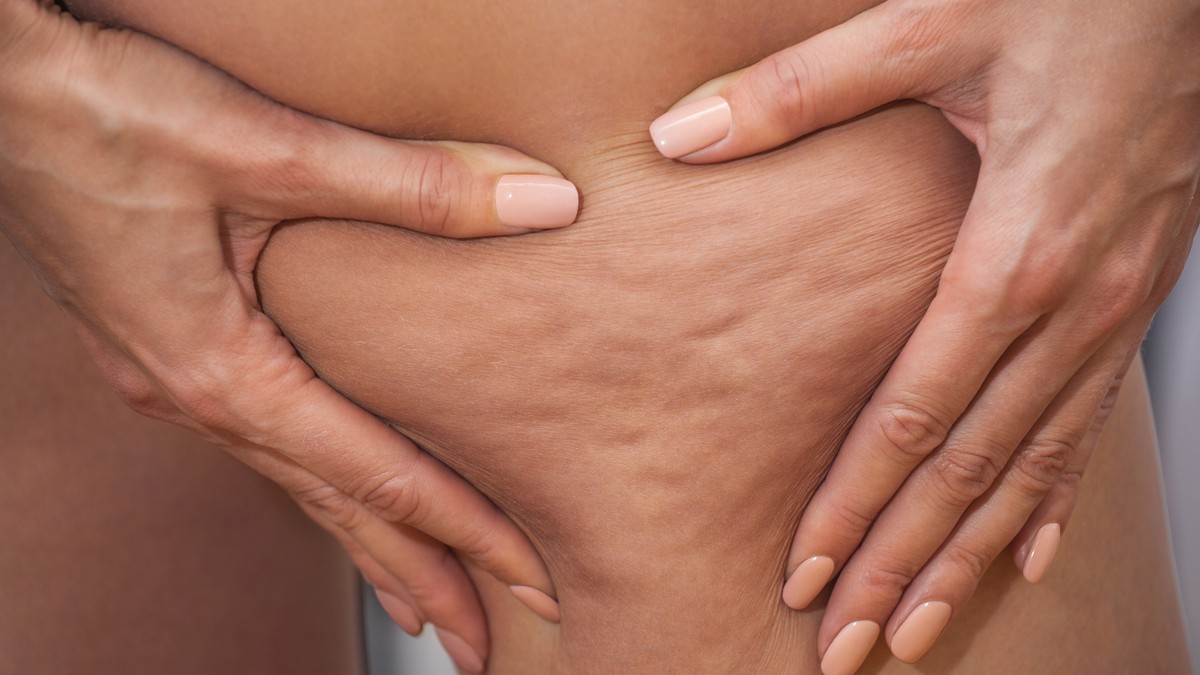 Stručnjaci upozoravaju da je važno razlikovati celulit od lipedema
