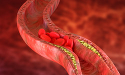 Jakie objawy ma miażdżyca aorty?
