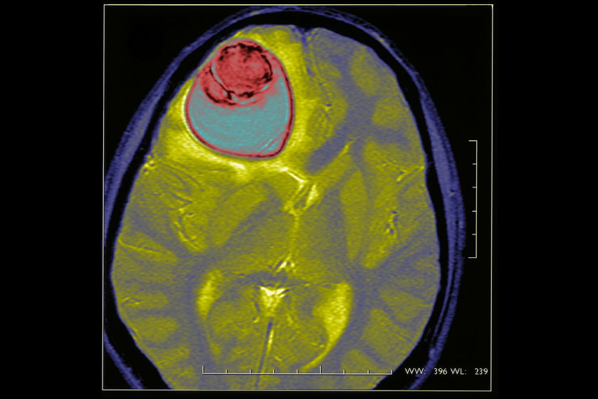 Padaczka i guz mózgu.
