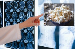 Popcornowe płuca. Brzmi niepoważnie, ale schorzenie jest bardzo groźne