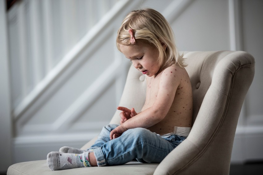 Ovako izgledaju varičele