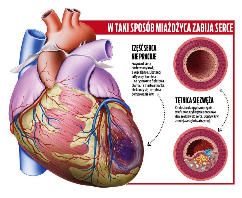 W taki sposób miażdżyca zabija serce 