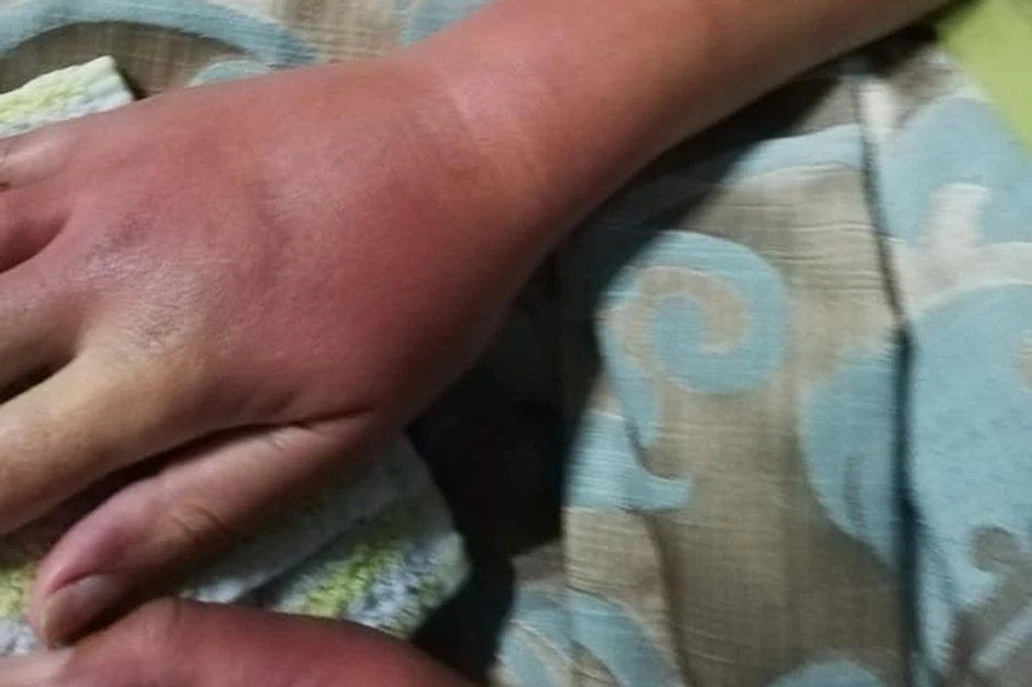 Zadobila teške povede