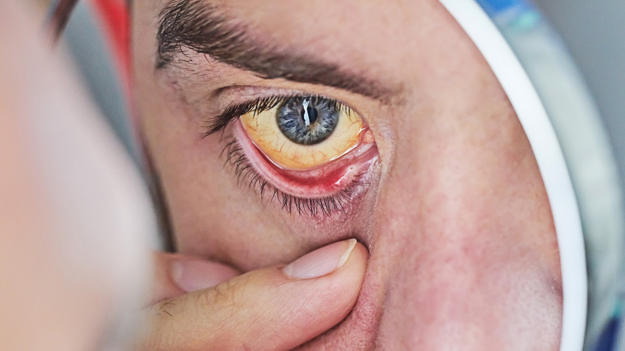 Žltačka, hepatitída. (ilustračné foto).