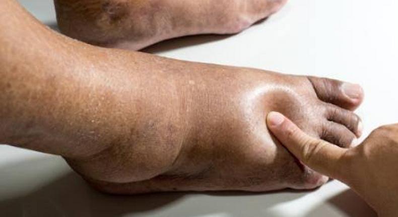 Leg swelling is also known as edema [Shutterstock]