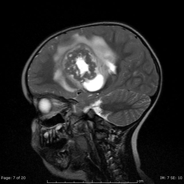 Metasztázisok az agyban: a koponyában nincs helye a tumornak | Rákgyógyítás