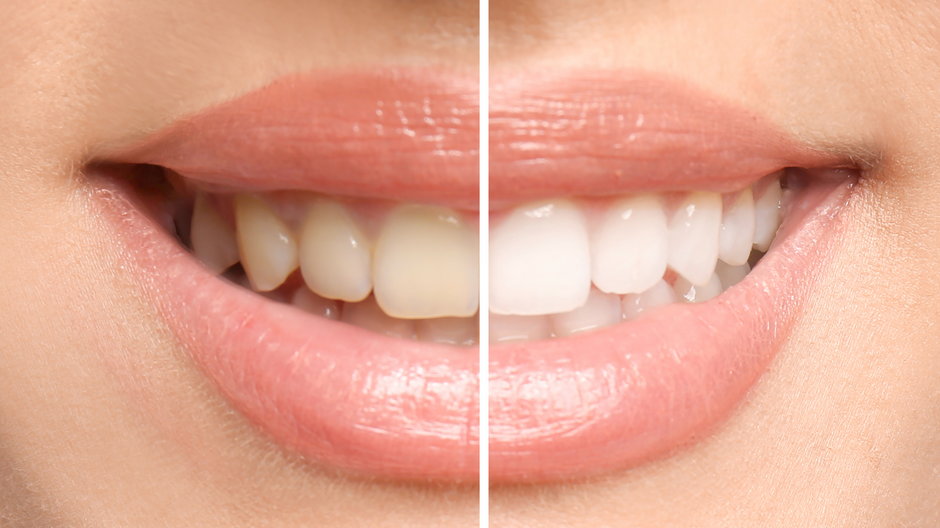 Zęby można rozjaśnić przy pomocy cytryny - New Africa/stock.adobe.com