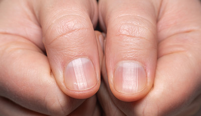 Prążki na paznokciach - czy są objawem choroby lub niedoboru witamin?  Mechaniczne uszkodzenia paznokcia