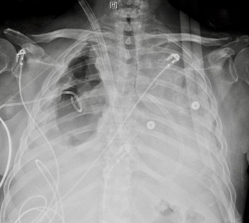 Snimak brajanovih pluća