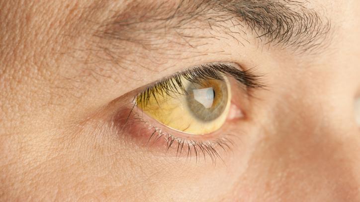 Sárgás szemfehérje: így jelzi a szemünk a daganatot