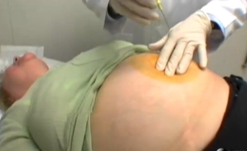 Gastrički bajpas smanjuje želudac, pa osoba uz manju količinu hrane postiže osećaj sitosti