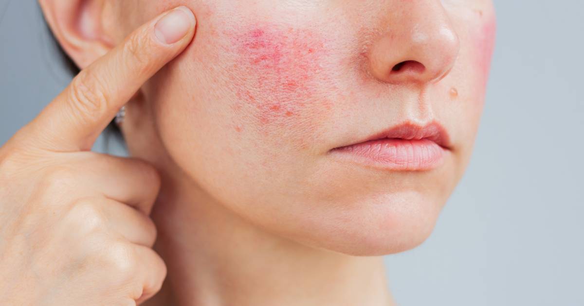 Ten tani krem domyka popękane naczynka jak laser. "W końcu pożegnałam czerwone pajączki"