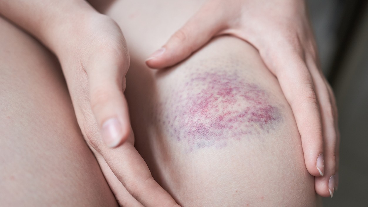 Modriny môžu byť signálom vitamínového deficitu.