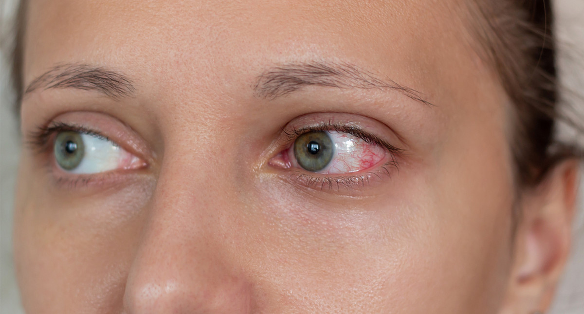 Zespół suchego oka – najskuteczniejsze sposoby na pozbycie się problemu