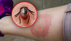 Doktorka u "Jutru na Blic" o zaštiti od krpelja: Jednu stvar nikako ne smete da uradite