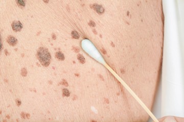 Májfoltok a bőrön: ebben az esetben gyanús, hogy hormonális gondot jelez