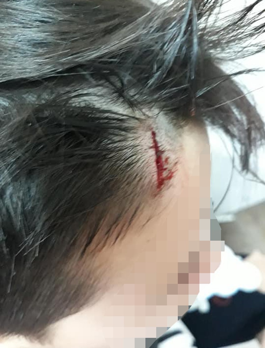 Vidljivu posekotinu na čelu dečak je zadobio prilikom udarca koji mu zadao drug iz odeljenja